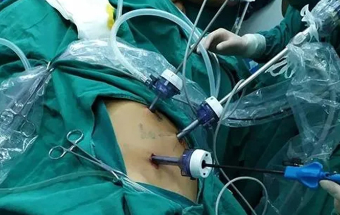 腹腔镜管线专用